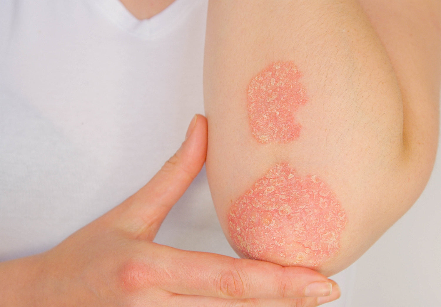 Say Goodbye to Eczema