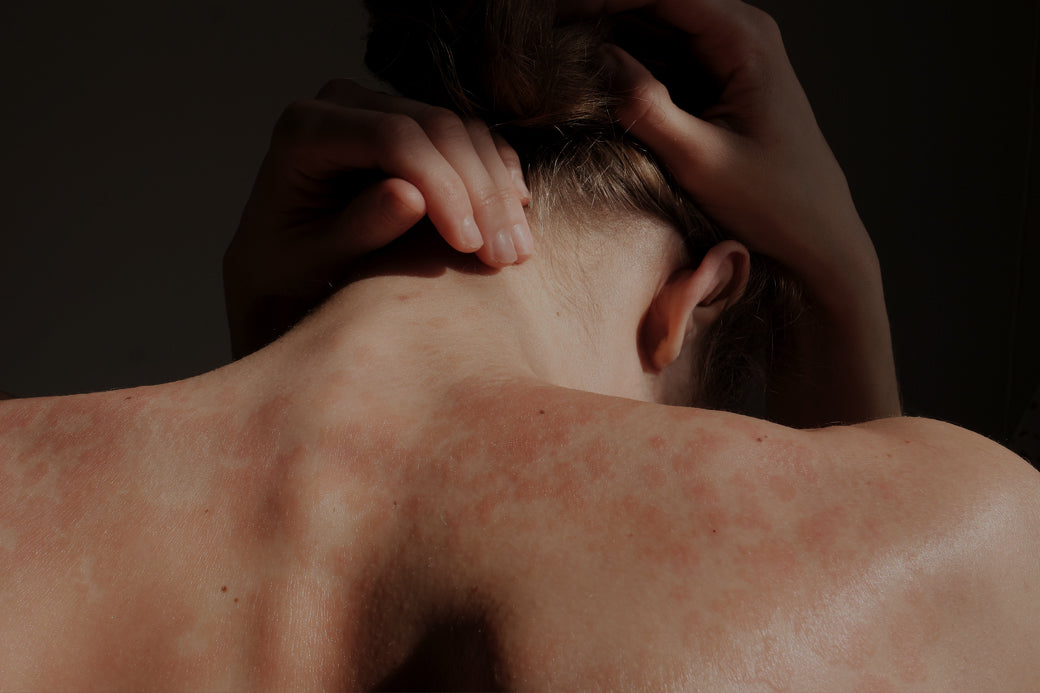 a girl with eczema on her back