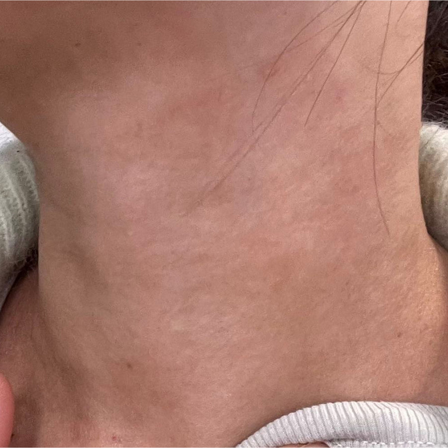Irritated neck