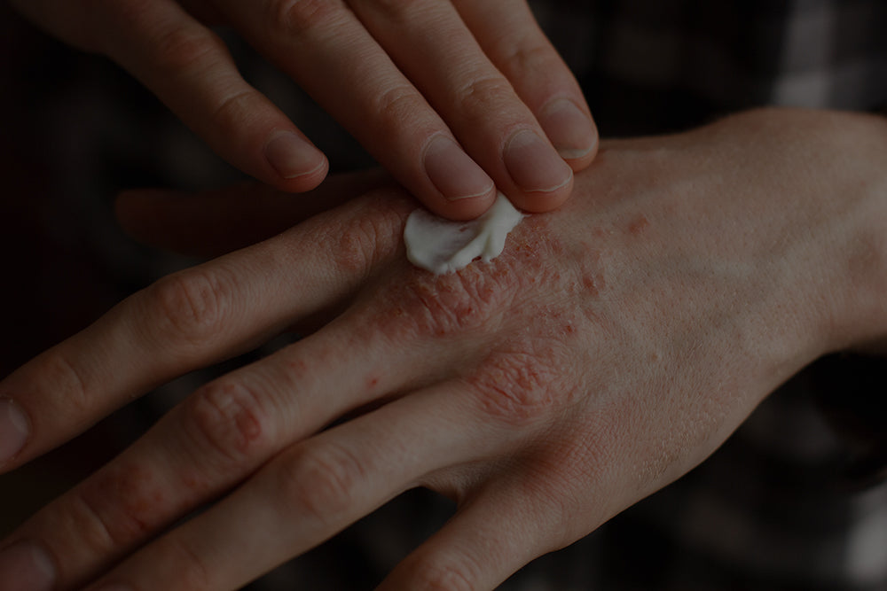 Eczema-prone skinneeds fewer battles.